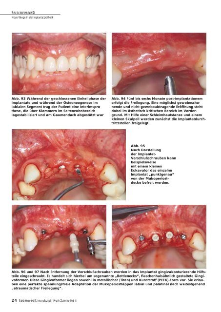 Sonderdruck Neue Wege in der Implantatprothetik - Alltec Dental