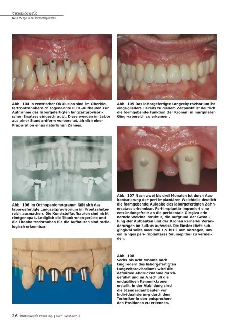 Sonderdruck Neue Wege in der Implantatprothetik - Alltec Dental