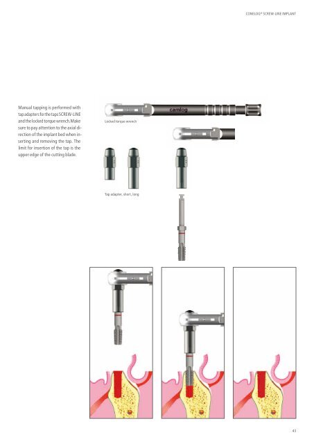 CONELOG® SURGICAL PROCEDURES - Camlog