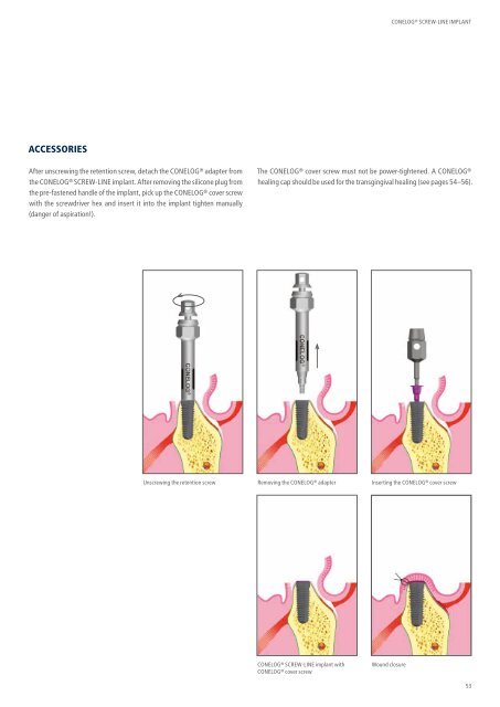 CONELOG® SURGICAL PROCEDURES - Camlog