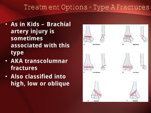 Distal Humeral Fractures - Dr. Kwee (Aug 22, 2006