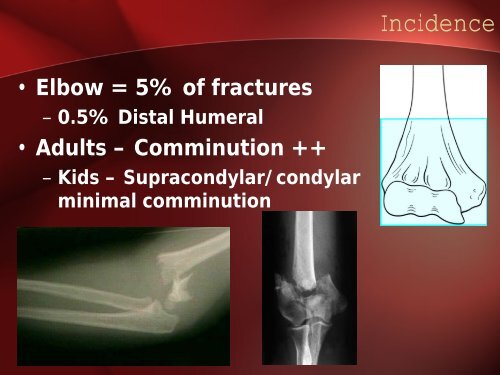 Distal Humeral Fractures - Dr. Kwee (Aug 22, 2006