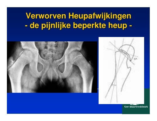 vallen en opstaan,kinderorthopedie