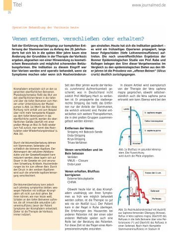 Venen entfernen, verschließen oder erhalten? - Deutsche ...