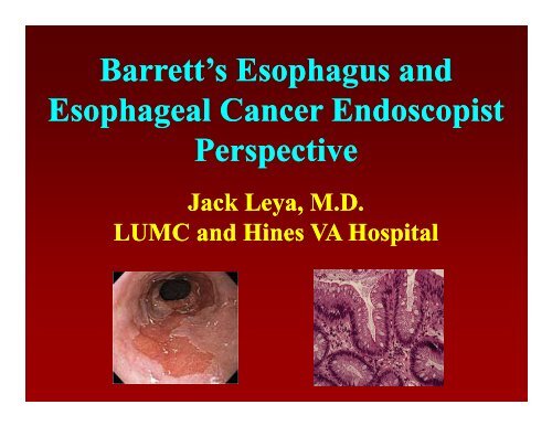 Barrett's Esophagus and Barrett s Esophagus and Esophageal ...