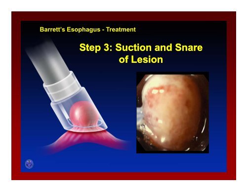 Barrett's Esophagus and Barrett s Esophagus and Esophageal ...