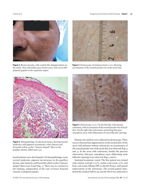 Hydroquinone-induced exogenous ochronosis - instituto de ...