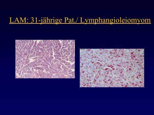 Lymphangioleiomyomatose (LAM) / Tuberöse Sklerose (TSC)