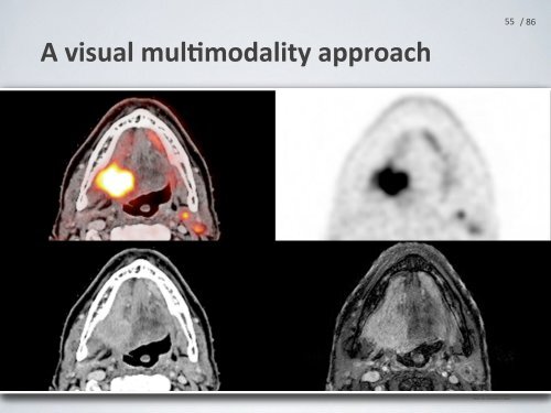 PET/CT for radiotherapy planning of head-Ã¢ÂÂneck cancer