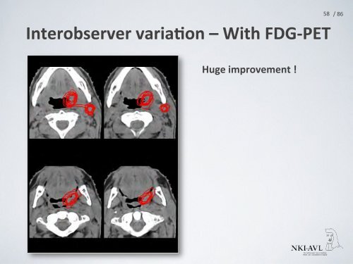 PET/CT for radiotherapy planning of head-Ã¢ÂÂneck cancer