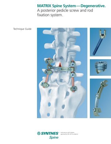 MATRIX Spine System—Degenerative. A posterior pedicle ... - Synthes