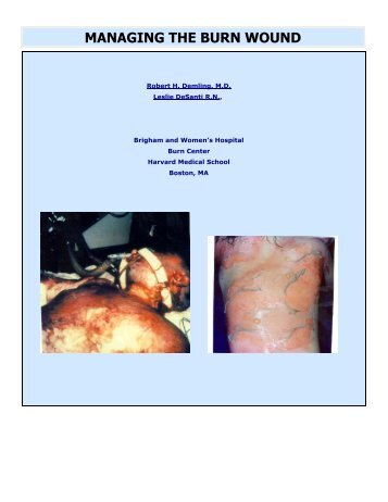 Managing the Burn Wound, part 1 of 4 - ePlasty
