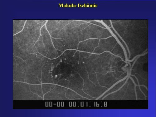 Angiographie bei Diabetes