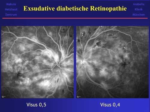 Angiographie bei Diabetes