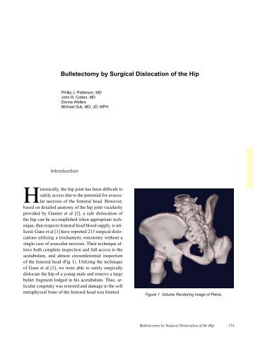 Bulletectomy by Surgical Dislocation of the Hip - TeraRecon