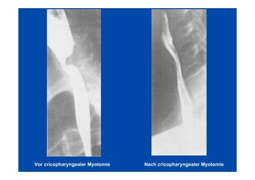 Neurogene Dysphagie