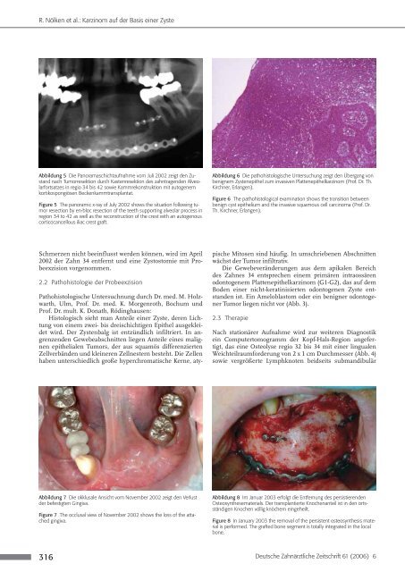Primäres intraossäres Plattenepithelkarzinom ... - Zahnheilkunde.de