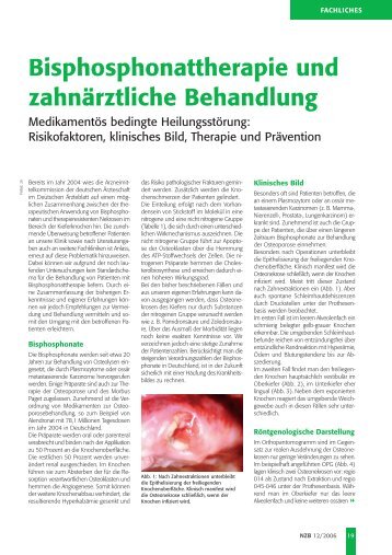 Bisphosphonattherapie und zahnärztliche Behandlung - Erste ...