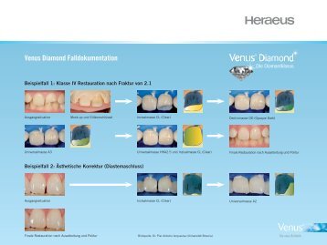 Venus Diamond Schichtanleitung - zahniportal.de