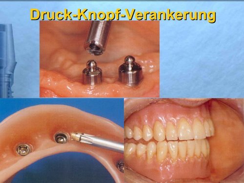 Ihre Zähne im Blickpunkt - Mehr Lebensqualität durch Zahnimplantate