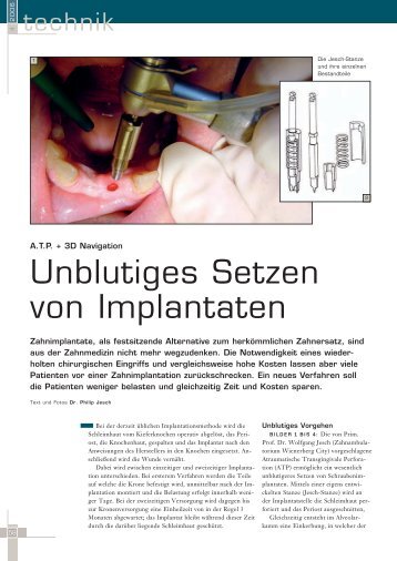 Unblutiges Setzen von Implantaten - Zahnambulatorium Wienerberg ...