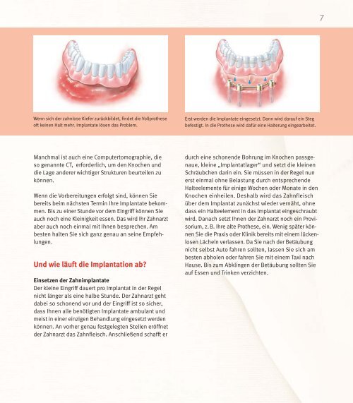 Implantatlösungen für den zahnlosen Kiefer - DENTSPLY Friadent