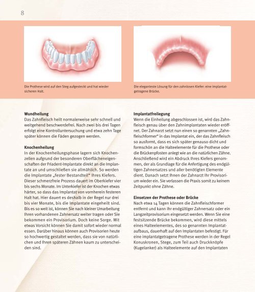 Implantatlösungen für den zahnlosen Kiefer - DENTSPLY Friadent