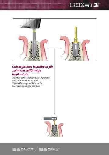 Chirurgisches Handbuch für zahnwurzelförmige ... - BIOMET 3i