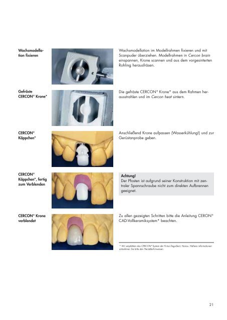 ANKYLOS® - DENTSPLY Friadent