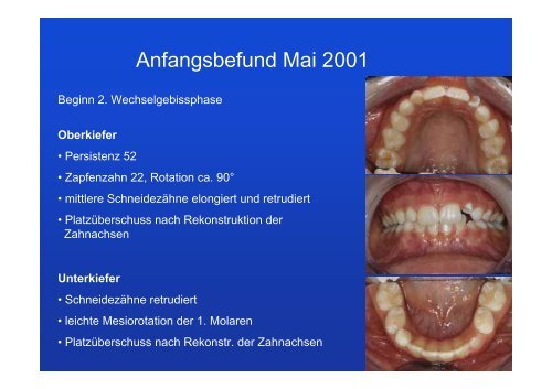 Lückenöffnung für Implantate - Lückenschluss statt Implantat 60 ...