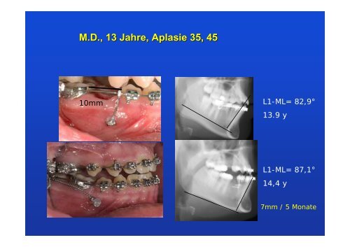 Lückenöffnung für Implantate - Lückenschluss statt Implantat 60 ...