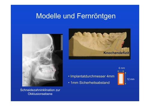 Lückenöffnung für Implantate - Lückenschluss statt Implantat 60 ...