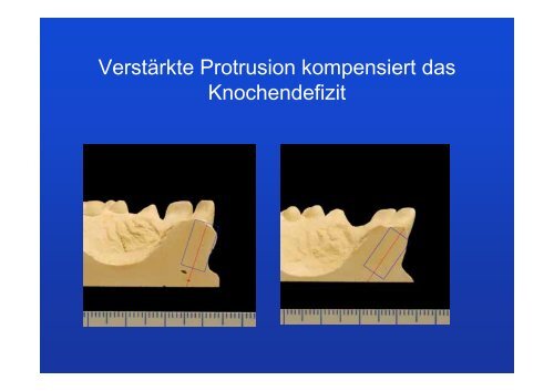 Lückenöffnung für Implantate - Lückenschluss statt Implantat 60 ...