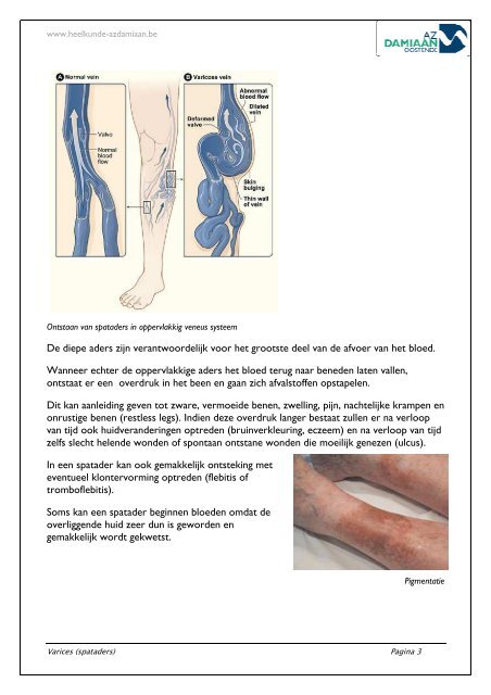 Wat zijn varices (spataders)? - Heelkunde AZ Damiaan, Oostende