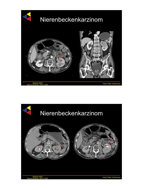 Frühe Bildgebung bei urologischen Tumoren