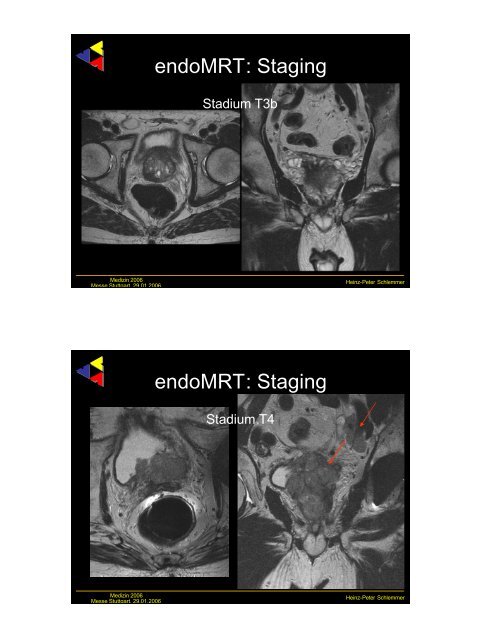 Frühe Bildgebung bei urologischen Tumoren