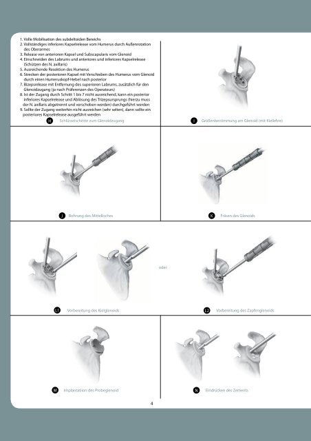 718-01-31 dt. Press-Fit OP Technik2 1 - tantum AG