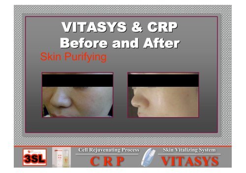 CRP Cell Rejuvenating Process VITASYS Skin Vitalizing System