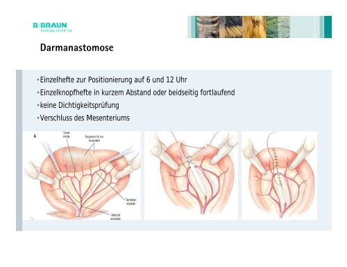 Moderne Nahtmaterialien und Nahttechniken der ChirurgieDr. Markus