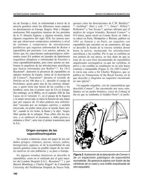 Historia de las espondiloartropatías seronegativas - Revista ...