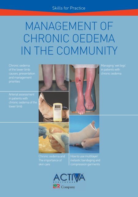 Management of Chronic Oedema in the Community - Wounds ...