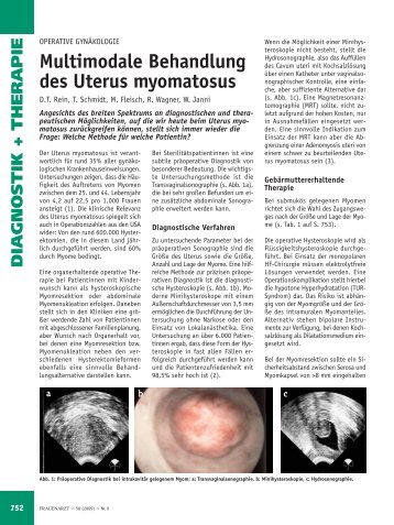 Multimodale Behandlung des Uterus myomatosus - Frauenarzt