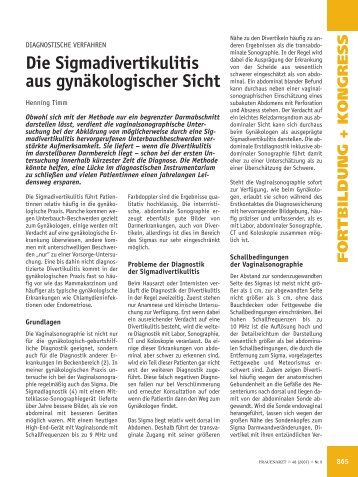 Die Sigmadivertikulitis aus gynäkologischer Sicht - Frauenarzt