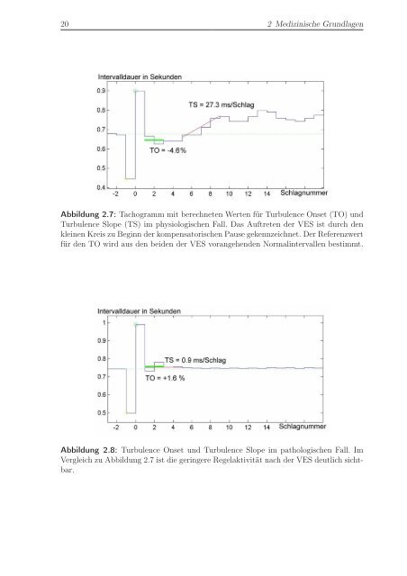 Entwicklung von Methoden zur Echtzeitanalyse von EKG ... - FZI