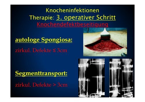 Knochendefektaufbau Segmenttransport - Septische Chirurgie