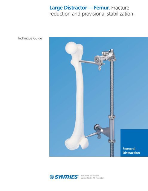 Large Distractor—Femur TG (PDF)