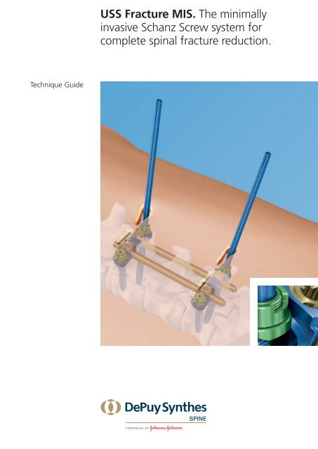 USS Fracture MIS. The minimally invasive Schanz Screw ... - Synthes