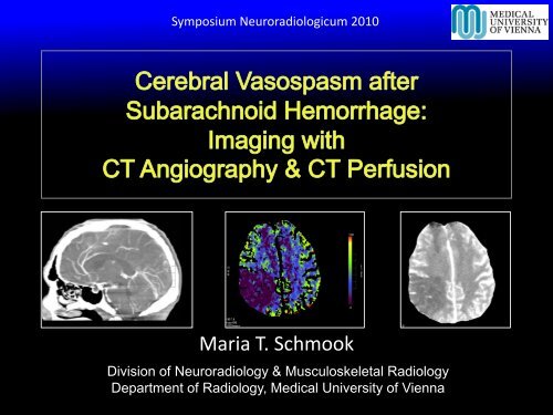 Cerebral Vasospasm after Subarachnoid Hemorrhage: Imaging with ...