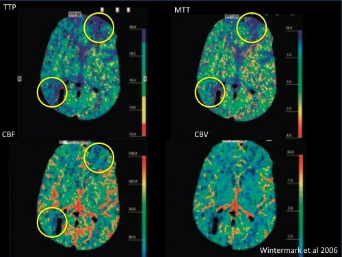 Cerebral Vasospasm after Subarachnoid Hemorrhage: Imaging with ...