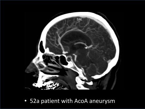 Cerebral Vasospasm after Subarachnoid Hemorrhage: Imaging with ...